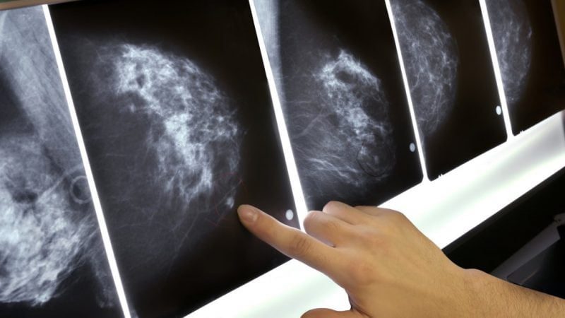 Scientists talked about inherited traits associated with breast cancer