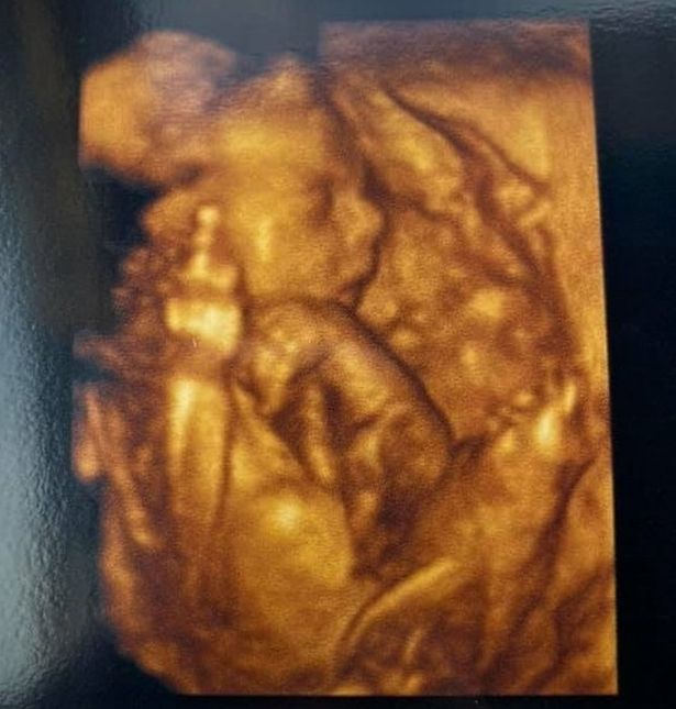 Parents in shock their baby in the womb showed the middle finger 2