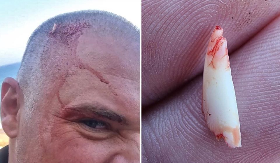 Shark broke a tooth on a mans head trying to bite him