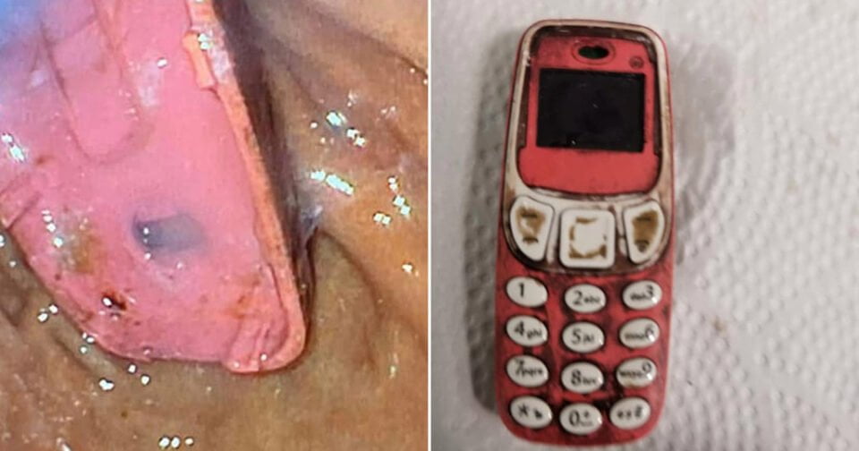 In Kosovo a man swallowed an old Nokia model and survived