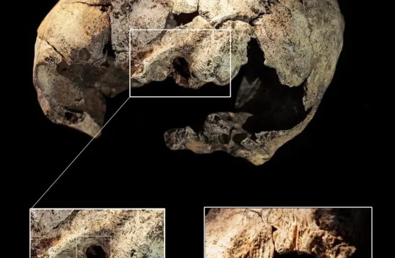 Archaeologists find evidence of first known ear surgery on 5 300 year old skull 2