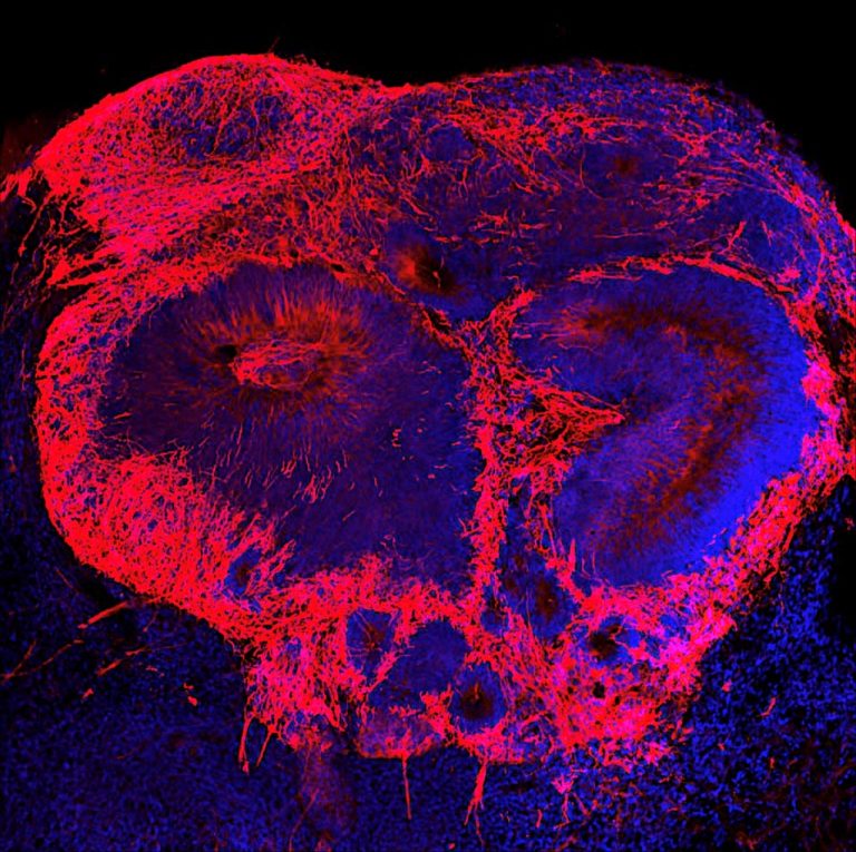 Mini Brains Grown in a Lab Provide Clues About Early Life Origins of Schizophrenia