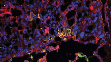 Neural stem cell therapy may improve metastatic cancer survival