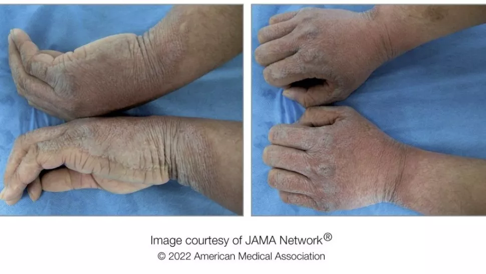 Excessive wrinkling on young mans hands turned out to be rare condition
