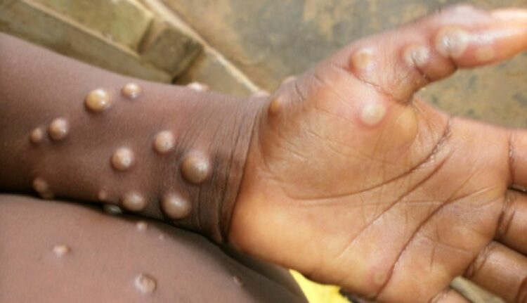 Monkeypox what is known about the prospects for a new pandemic 7 1