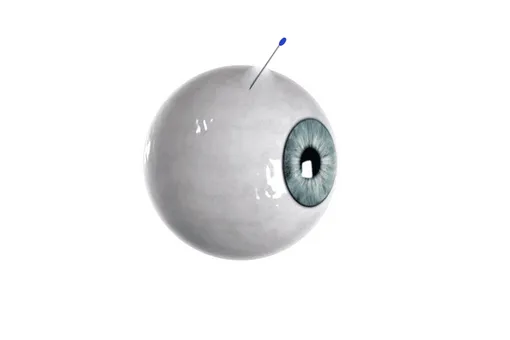 Created a microneedle for the eye which clogs the hole behind it and decomposes inside the eyeball
