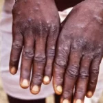 Monkeypox may have been circulating outside of Africa for several years