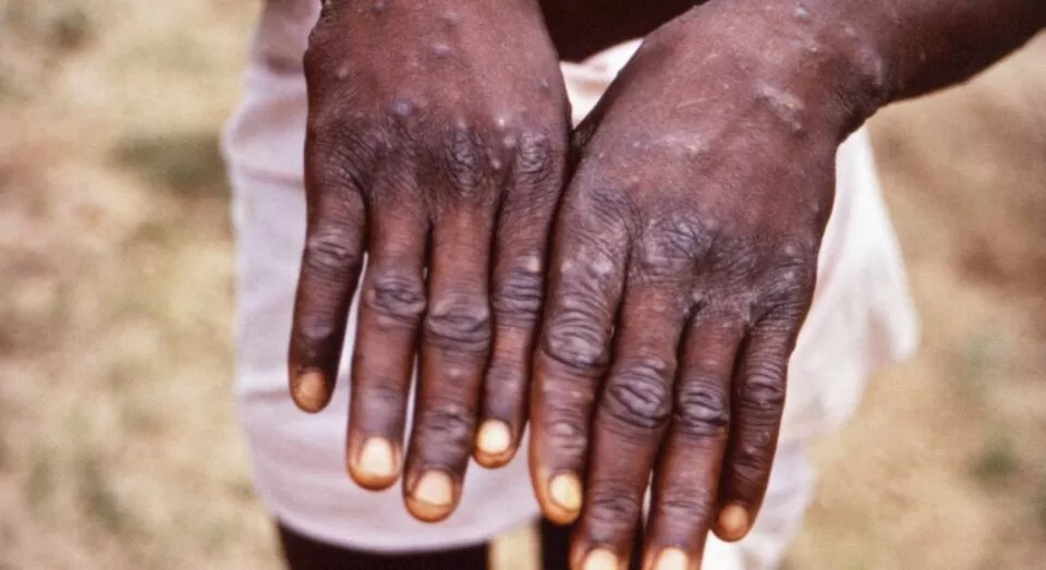 Monkeypox may have been circulating outside of Africa for several years