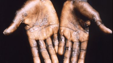 WHO draws portrait of typical monkeypox patient 1