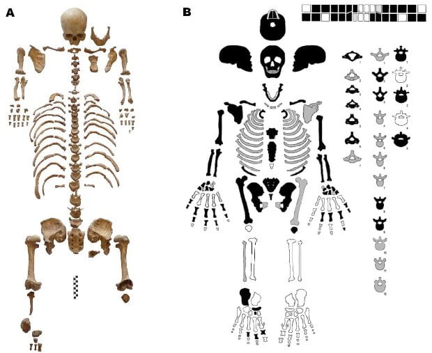 Remains of medieval dwarf found in Poland 3