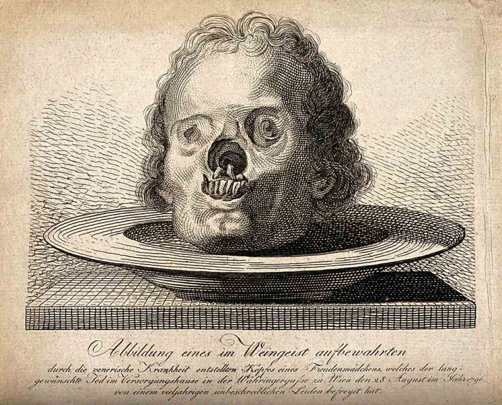 Child 'treated' for syphilis found in plague grave in Sardinia 1 Child treated for syphilis found in plague grave in Sardinia 1
