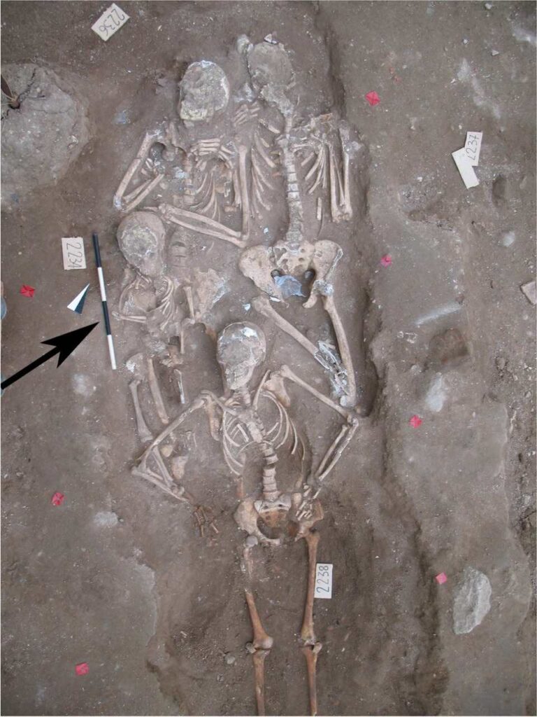 Child treated for syphilis found in plague grave in Sardinia 2 Child treated for syphilis found in plague grave in Sardinia 2