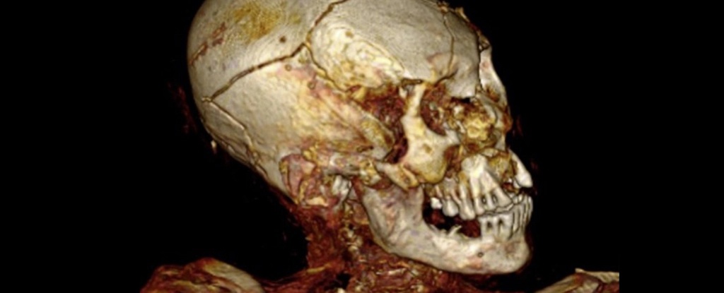 South American mummies were brutally murdered computed tomography showed