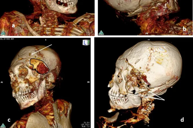 Virtual autopsy reveals two South American mummies brutally murdered 1