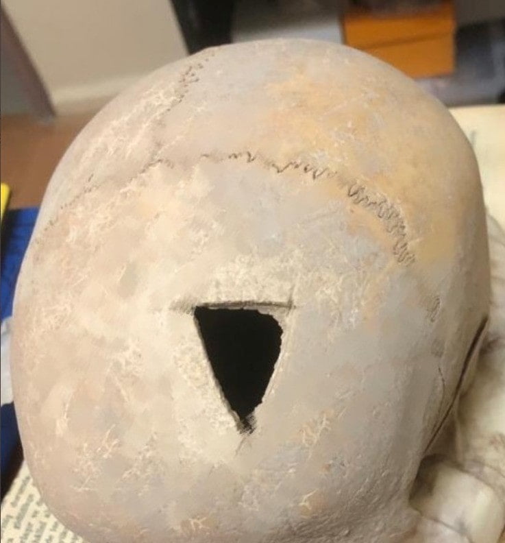 3 200 year old trepanned skull discovered in Van province in eastern Turkey