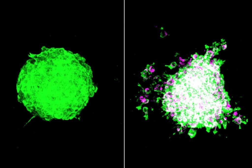 Scientists show how bacteria help tumors overcome immune defenses and metastasize
