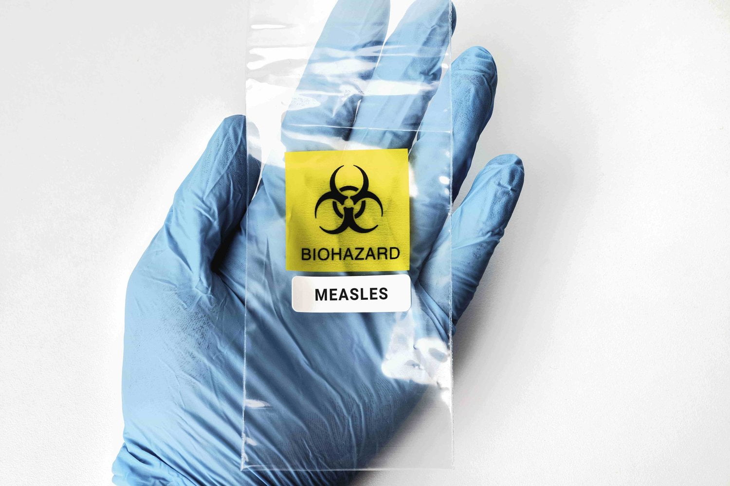 global spread of measles 1