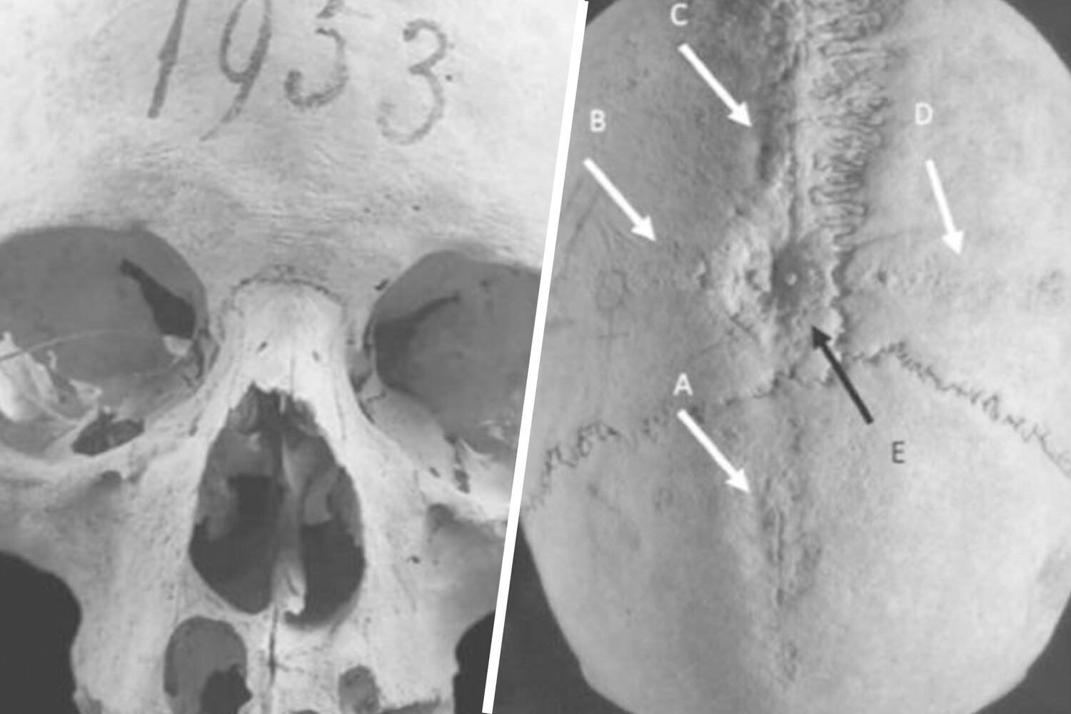 Archaeologists have discovered traces of trepanation on the skull of a medieval woman