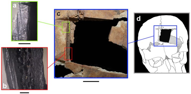 inhabitants of Israel performed operations on the skull at least 3500 years ago 2